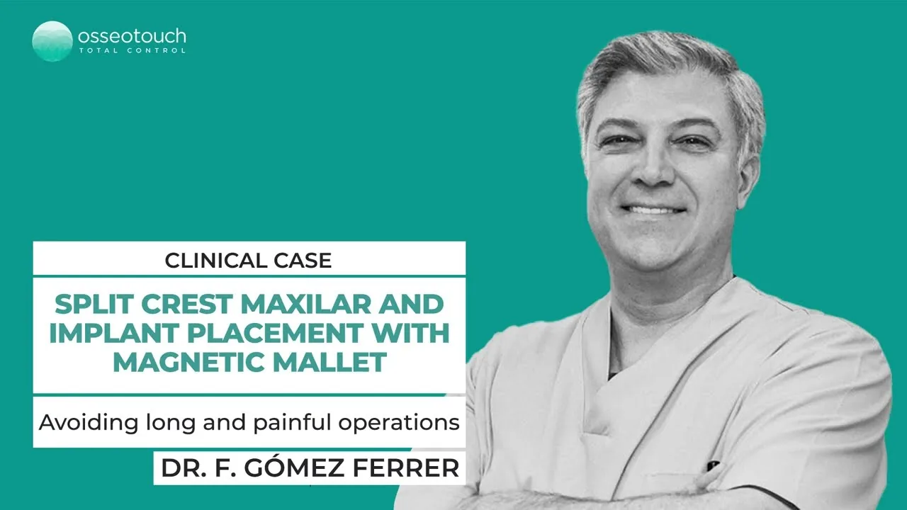 Dr. Fernando Gomez-Ferrer — split crest maxilla and implant placement with Magnetic Mallet