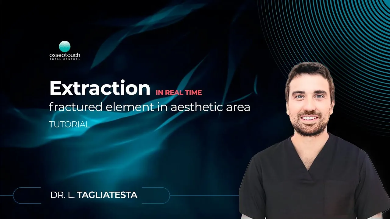 Kit Essential clinical case — real-time atraumatic extraction
