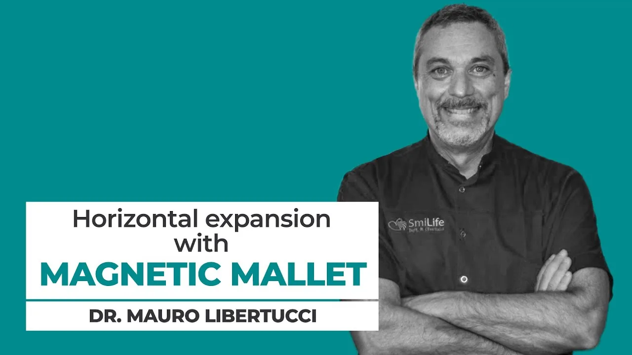 Dr. M. Libertucci — split crest and sinus lift simultaneous with Magnetic Mallet