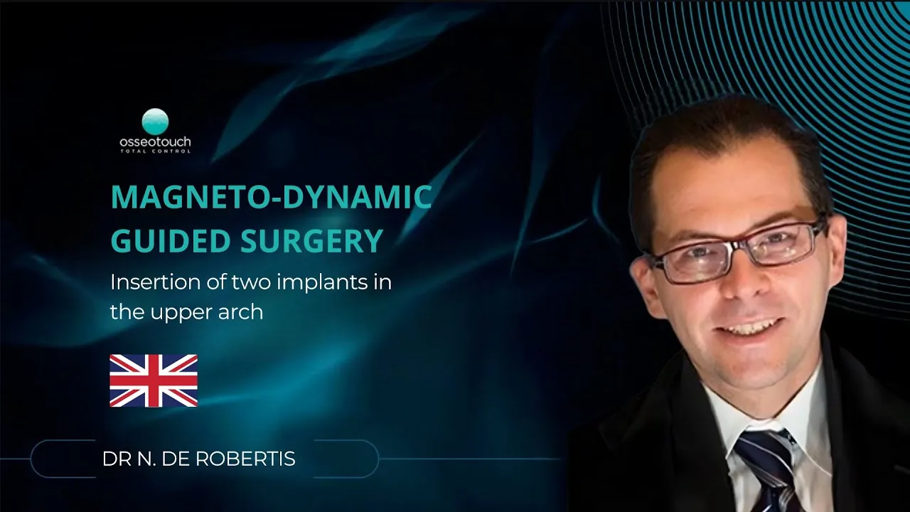 Magnetodynamic guided surgery — placement of two implants in the upper arch