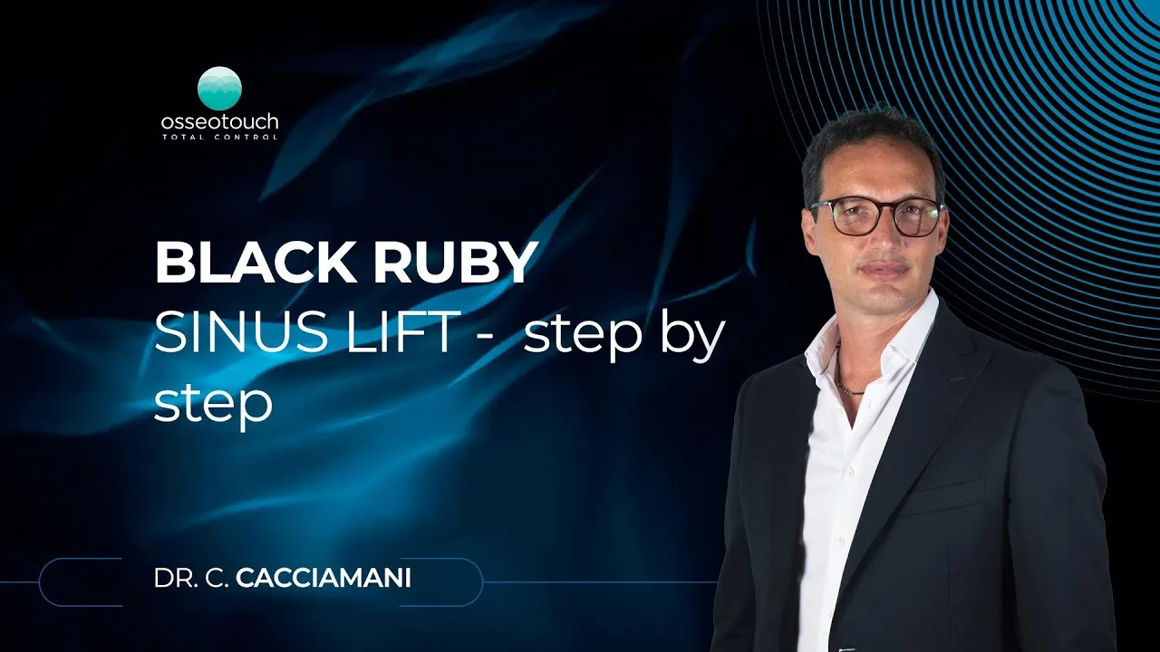 Crestal sinus lift step-by-step procedure with Black Ruby DLC osteotomes